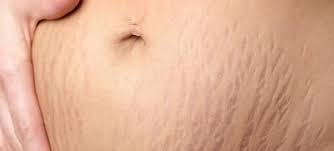 کرم درمان ترک بدن وکالی WOKALI